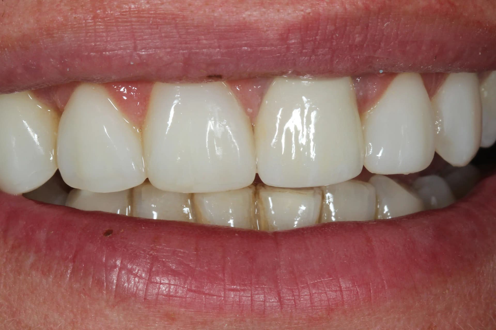 After Estetică Dentară: Coroană Ceramică și Fațetări Directe