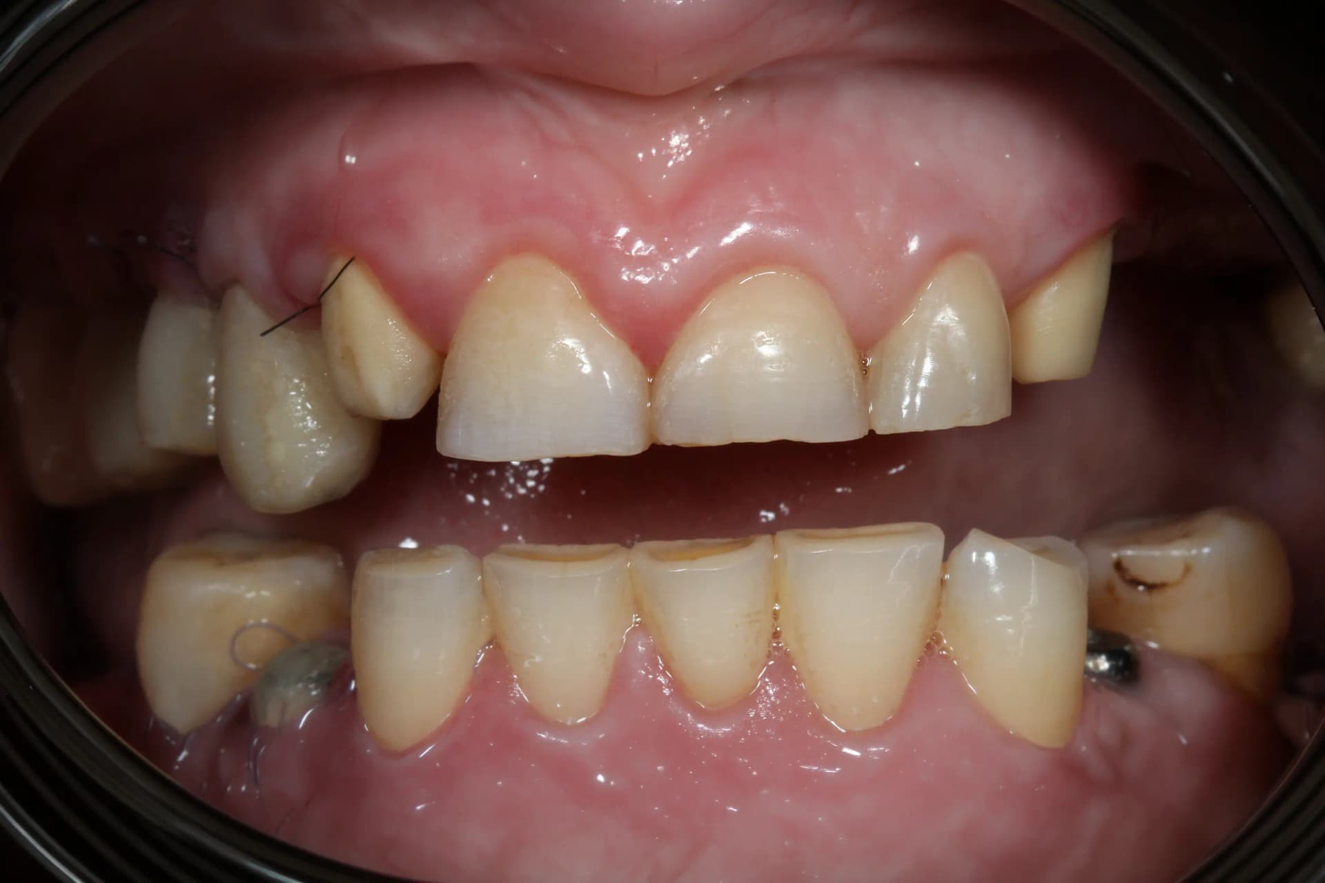 Before Reabilitare Orală Completă: Armonie Funcțională și Estetică Naturală