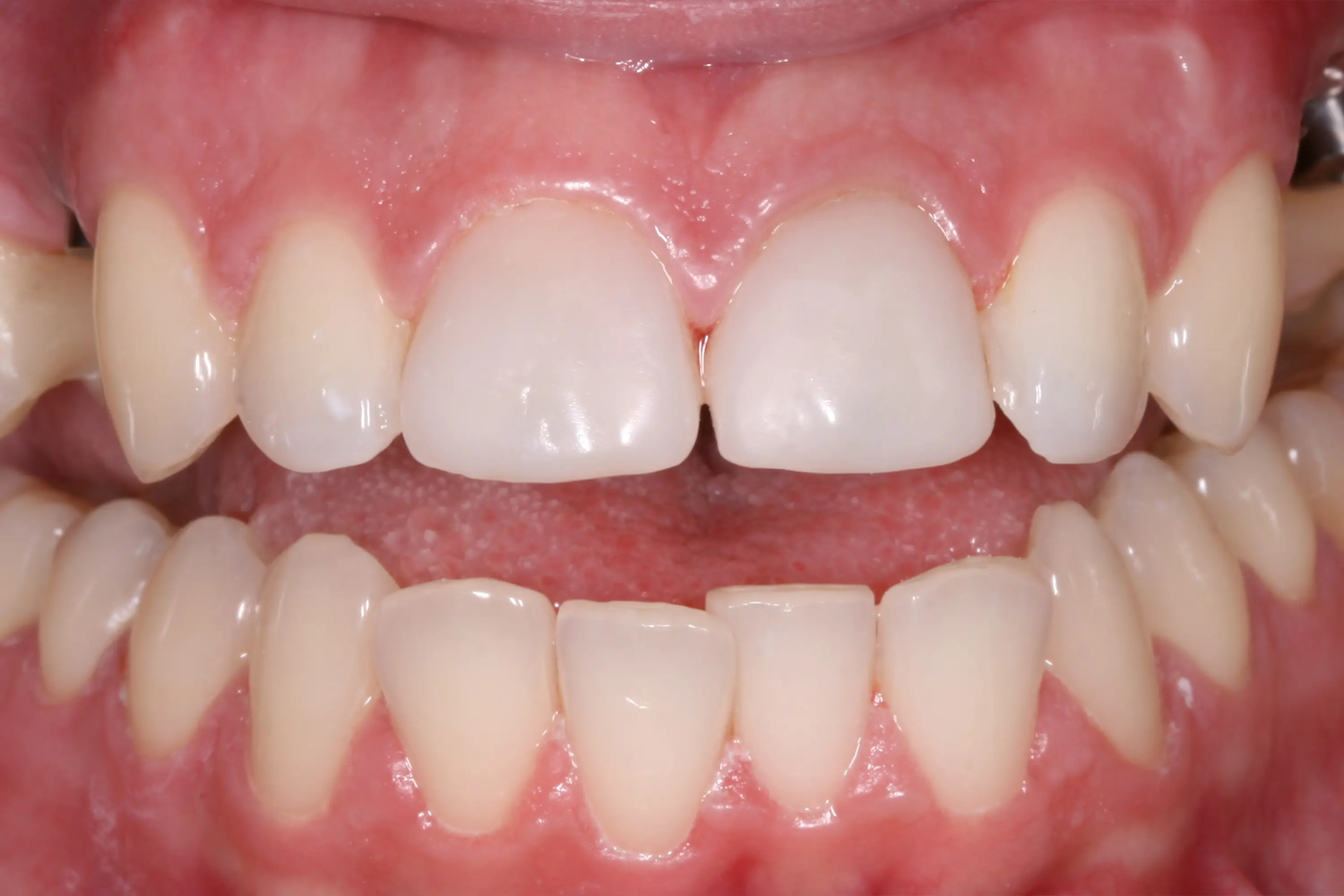 Before Zâmbet Reconstruit: Corectarea Traumatismelor și Edentațiilor printr-o Reabilitare Totală