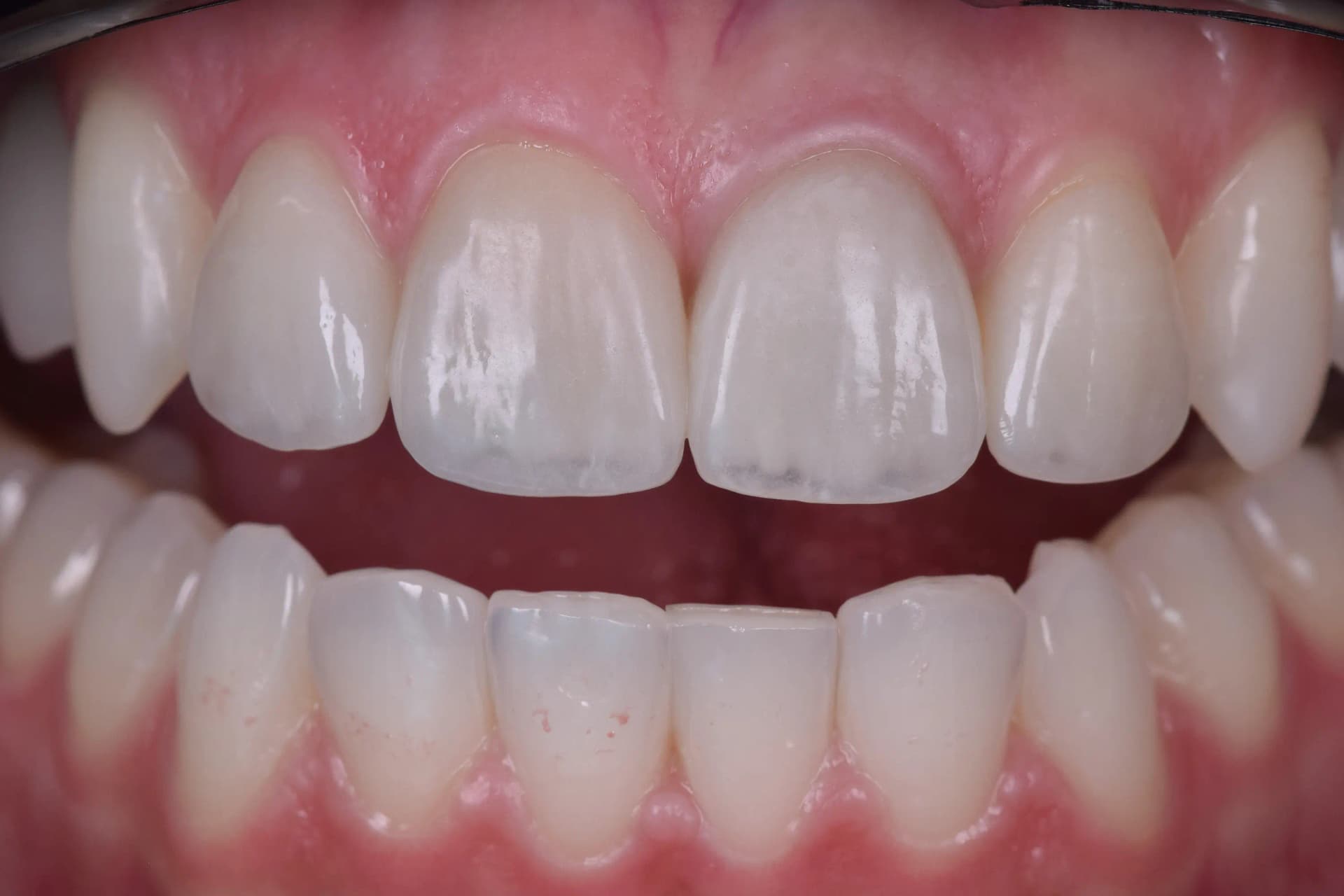 After Zâmbet Reconstruit: Corectarea Traumatismelor și Edentațiilor printr-o Reabilitare Totală