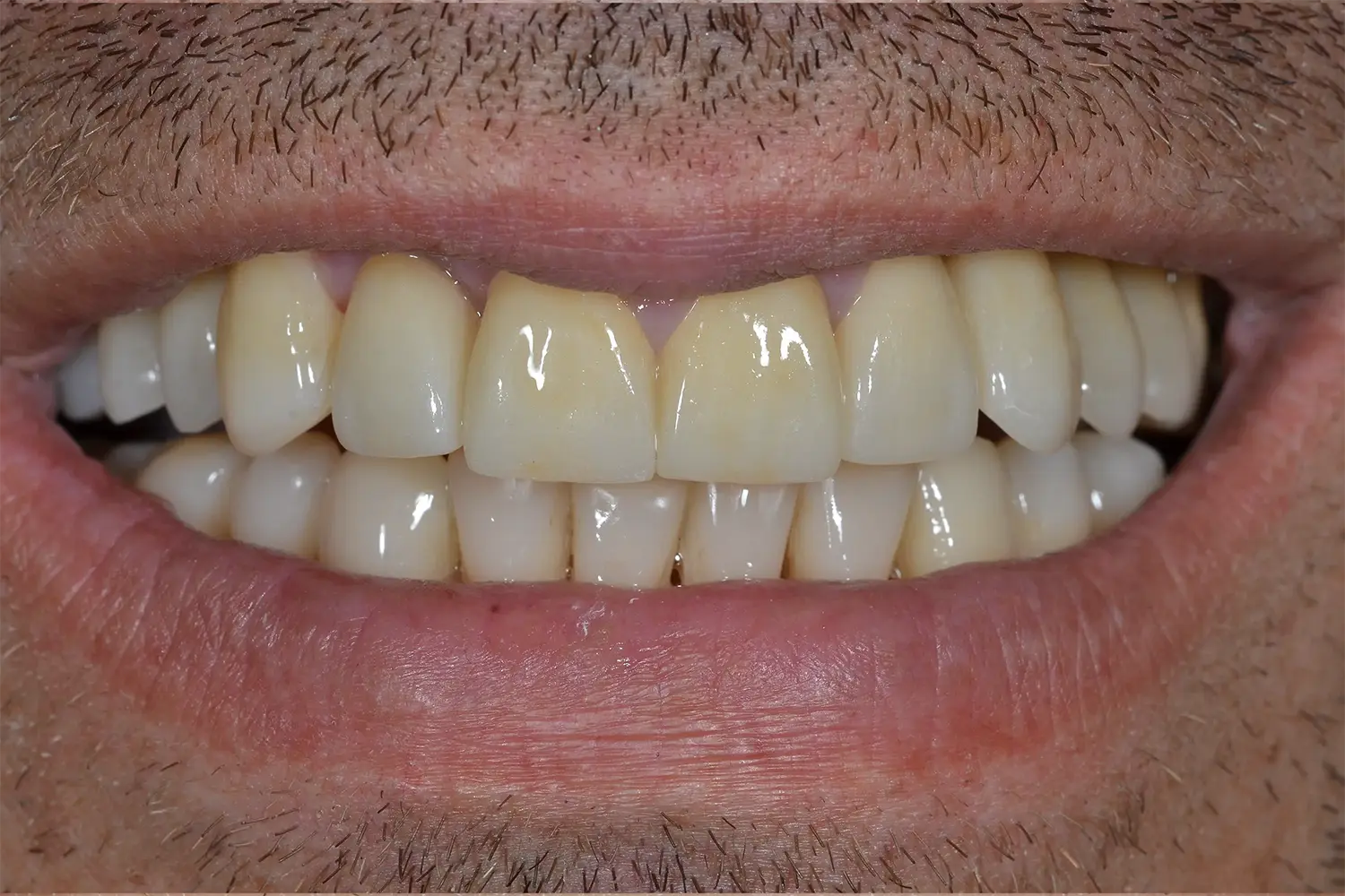 Reabilitare Orală Completă: Armonie Funcțională și Estetică Naturală – foto 2