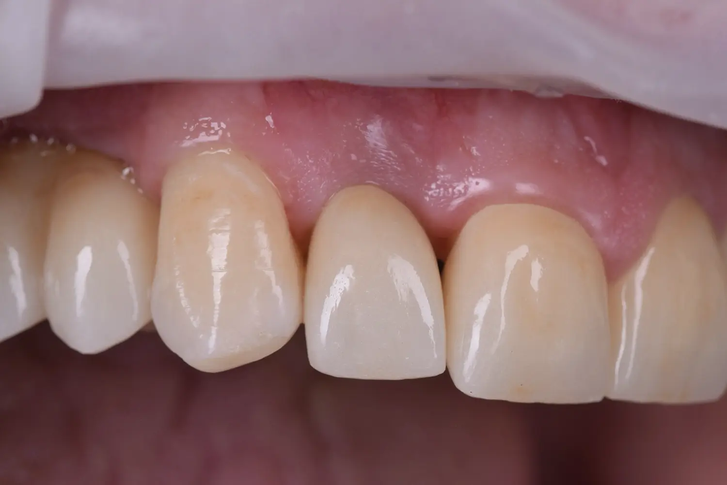 Reabilitare Orală Completă: Armonie Funcțională și Estetică Naturală – foto 4