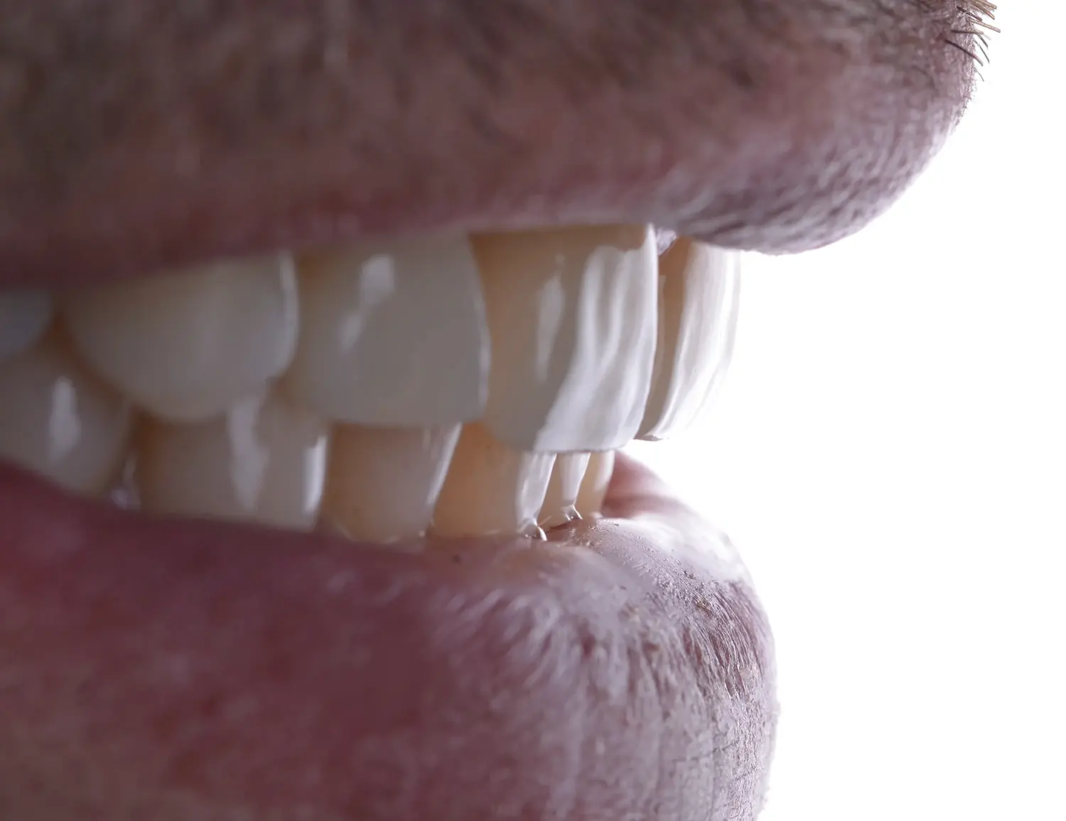 Reabilitare Orală Completă: Armonie Funcțională și Estetică Naturală – foto 6