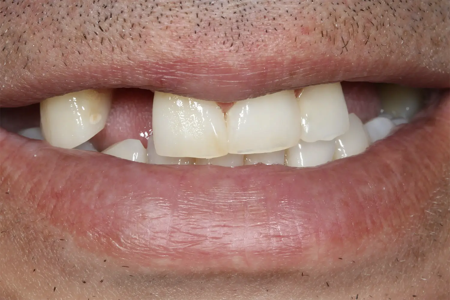 Before Reabilitare Orală Completă: Armonie Funcțională și Estetică Naturală