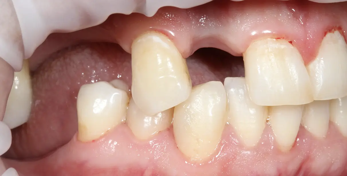 Reabilitare Orală Completă: Armonie Funcțională și Estetică Naturală – foto 3