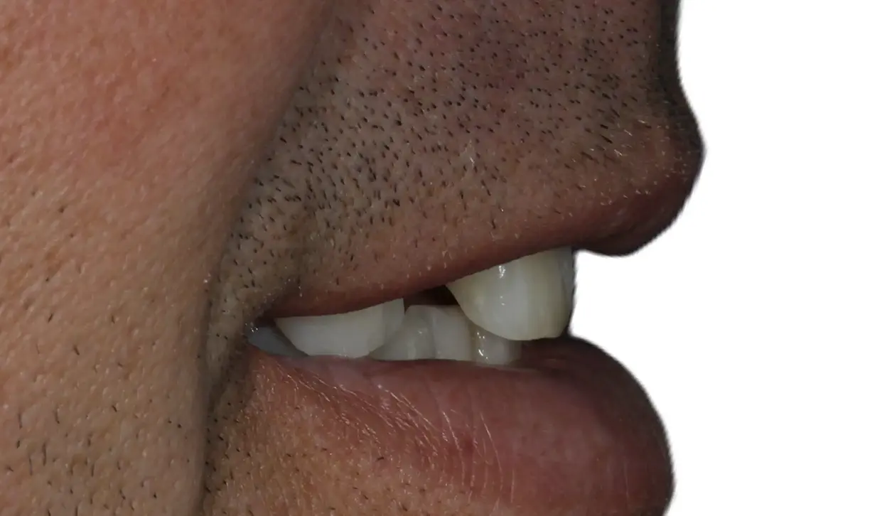 Reabilitare Orală Completă: Armonie Funcțională și Estetică Naturală – foto 5