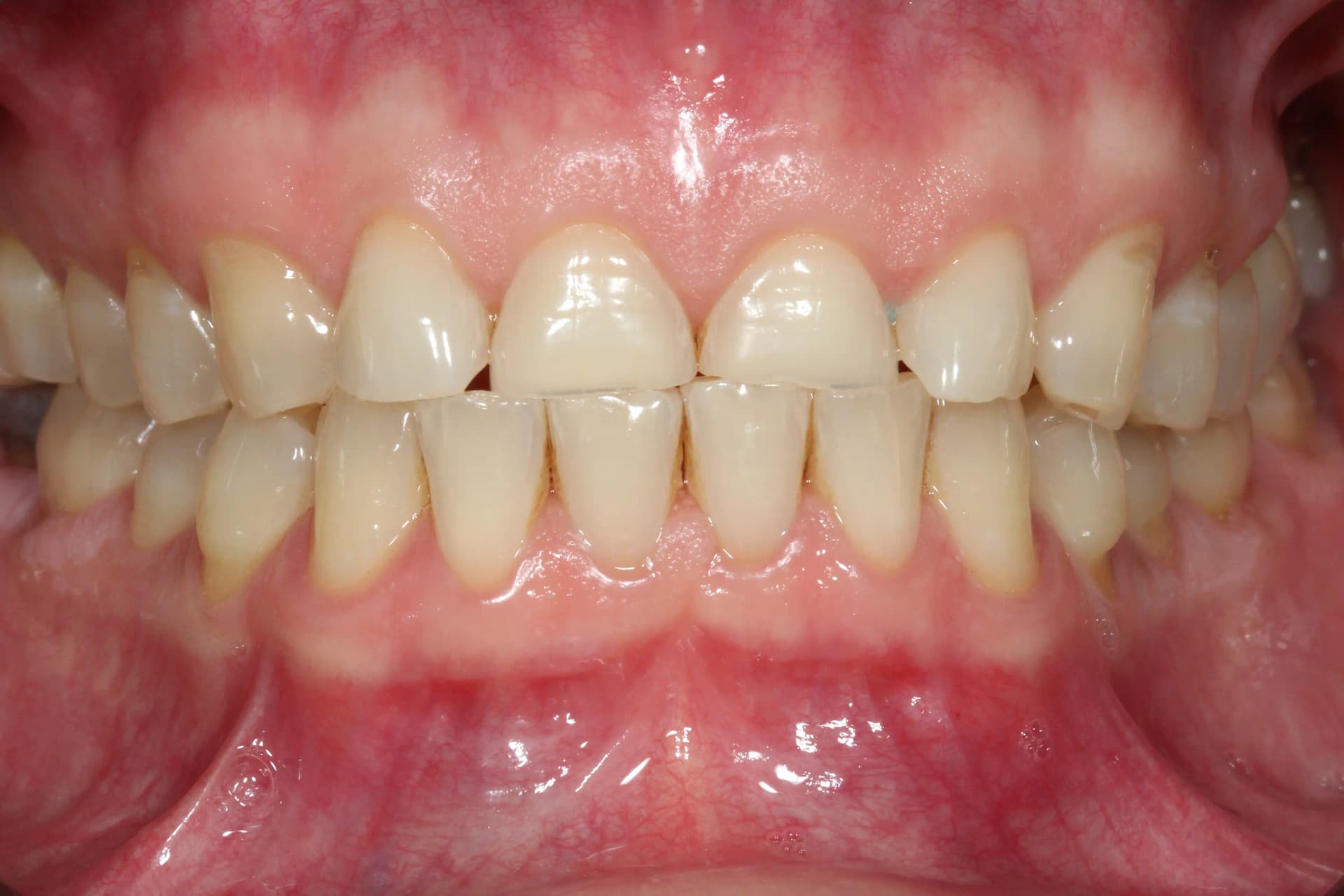 Before Reabilitare Totală: Uzură Dentară Generalizată