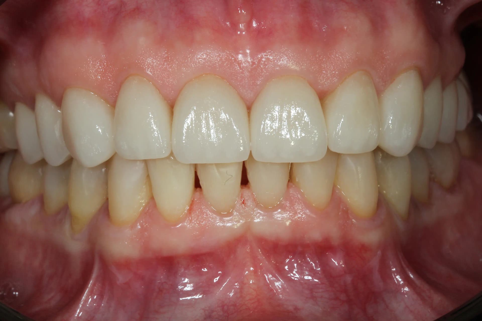 After Reabilitare Totală: Uzură Dentară Generalizată