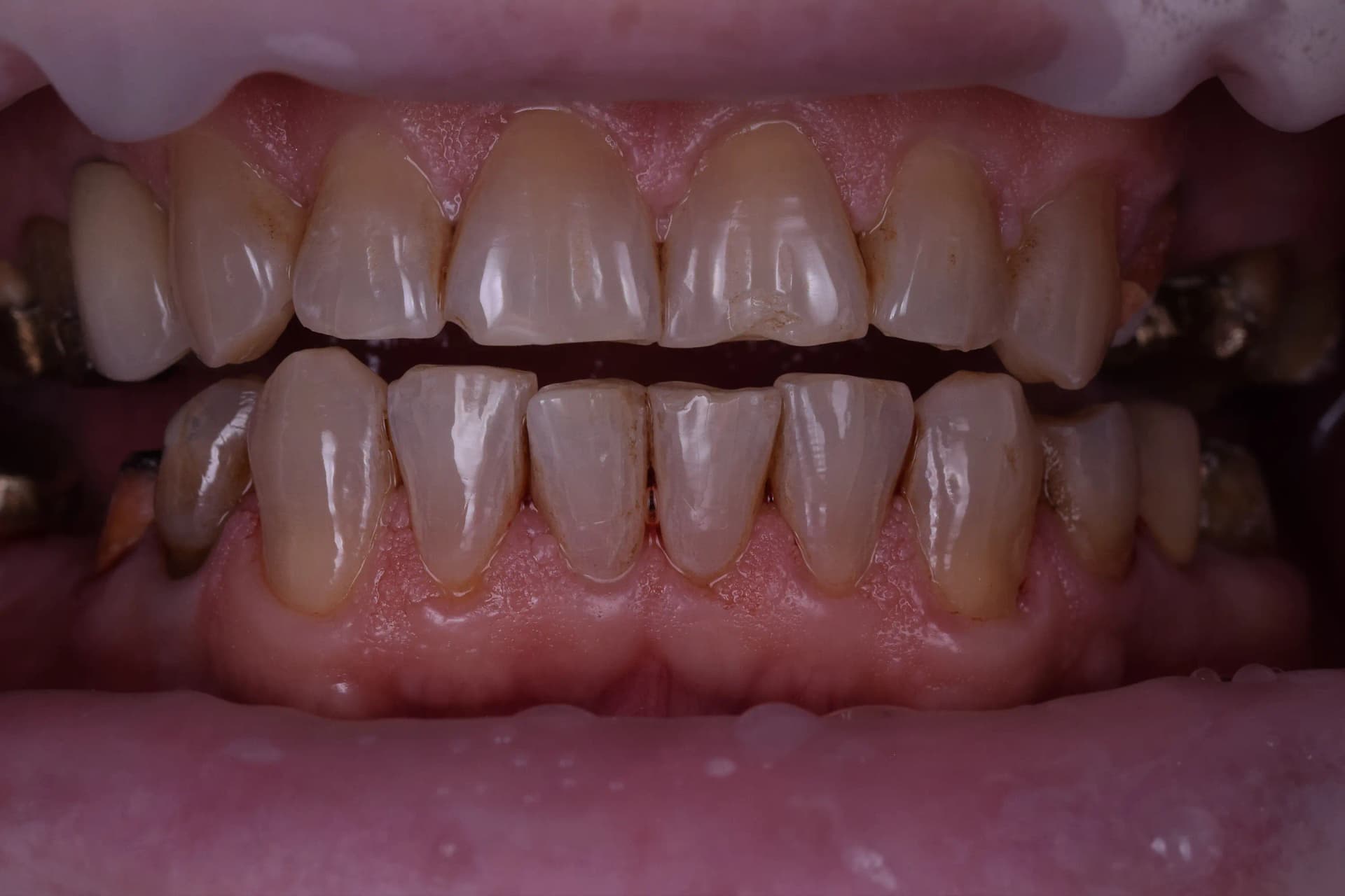 Before Reabilitare Estetică și Funcțională: Redescoperirea unui Zâmbet Tânăr