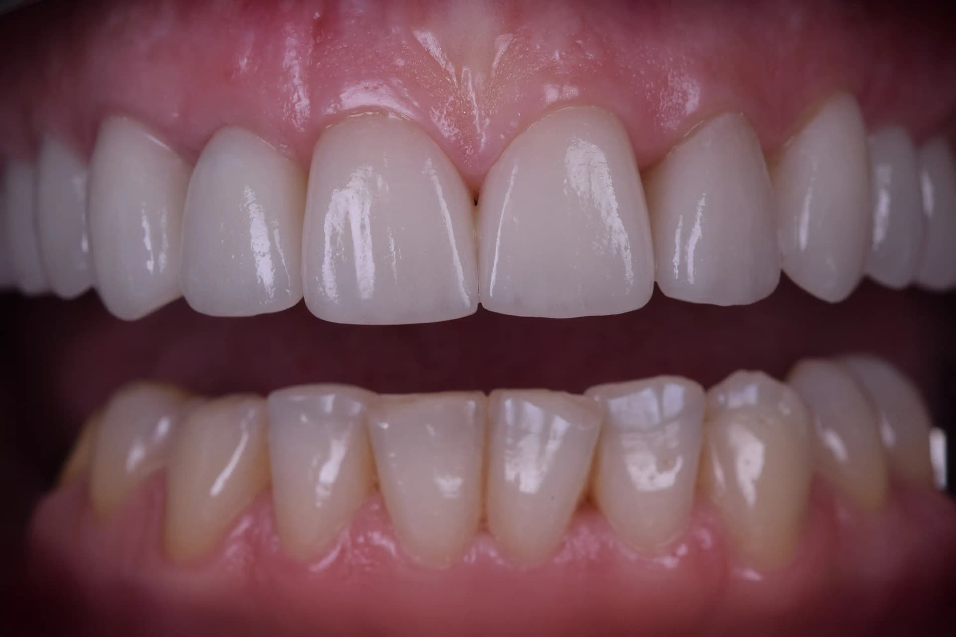 After Reconstrucție Totală: De la Structură Compromisă la Perfecțiune Estetică