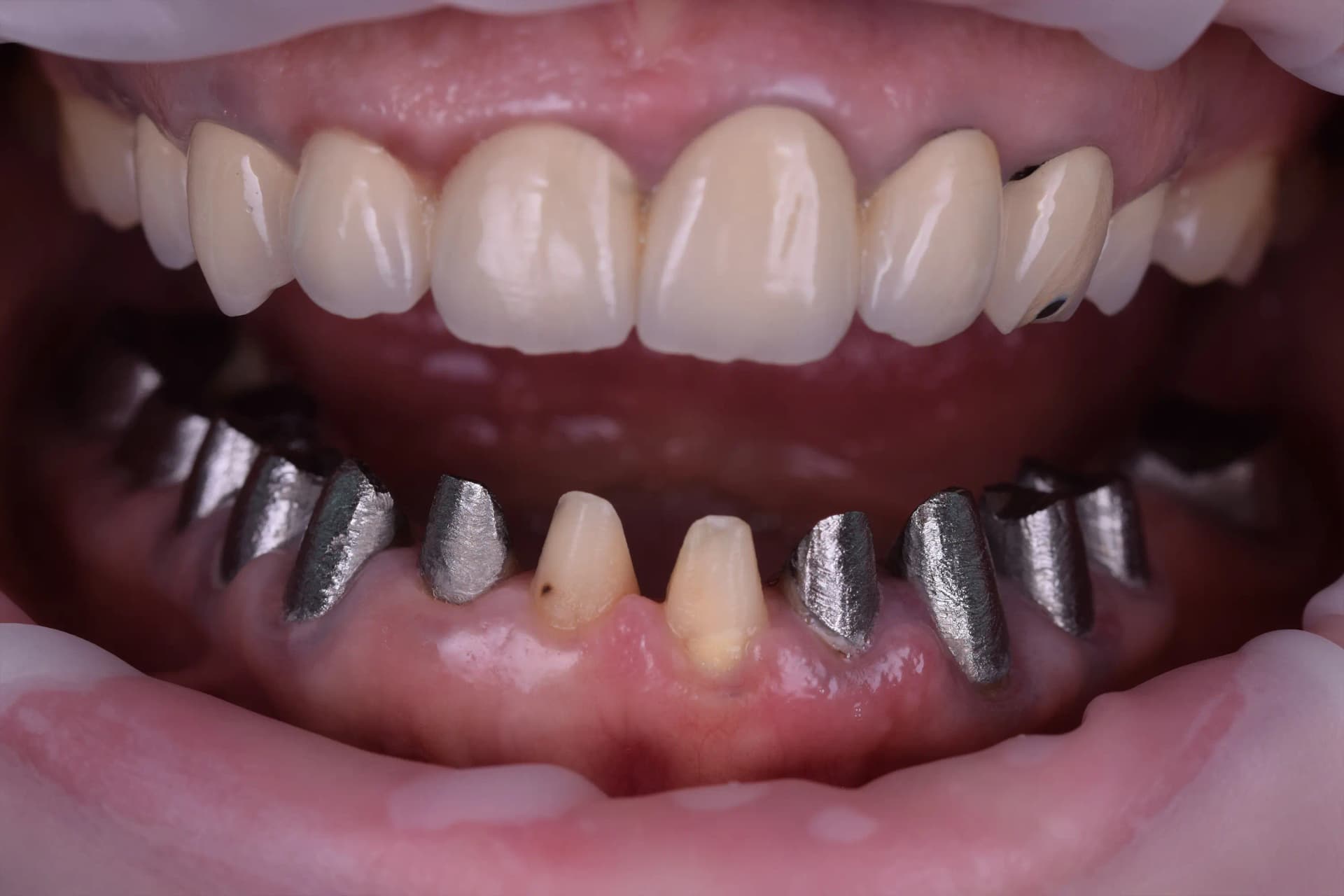 Before Rejuvenare Dentară Minim Invazivă: Corectarea Uzurii și Redobândirea Strălucirii