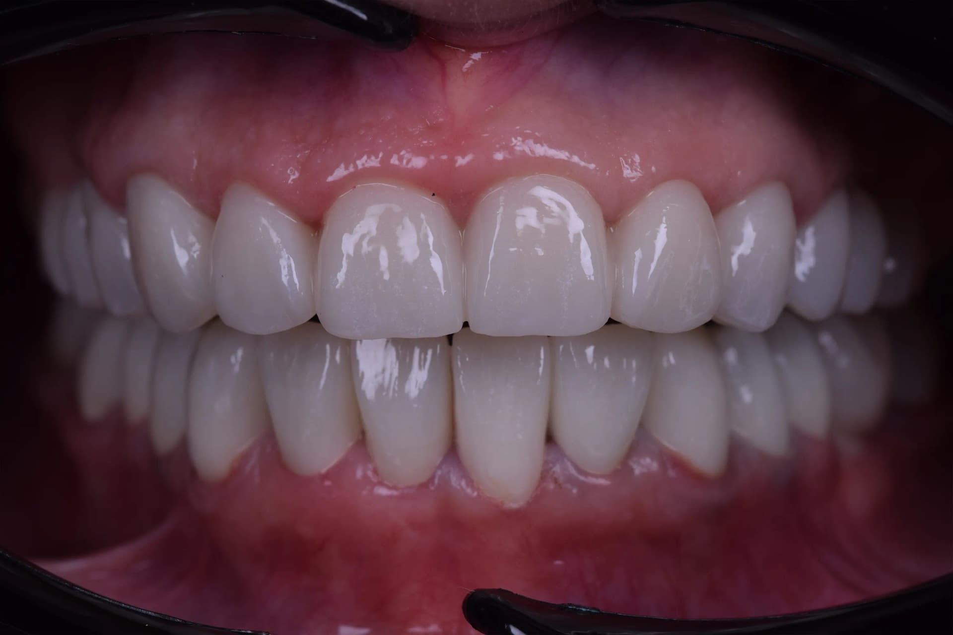 After Rejuvenare Dentară Minim Invazivă: Corectarea Uzurii și Redobândirea Strălucirii