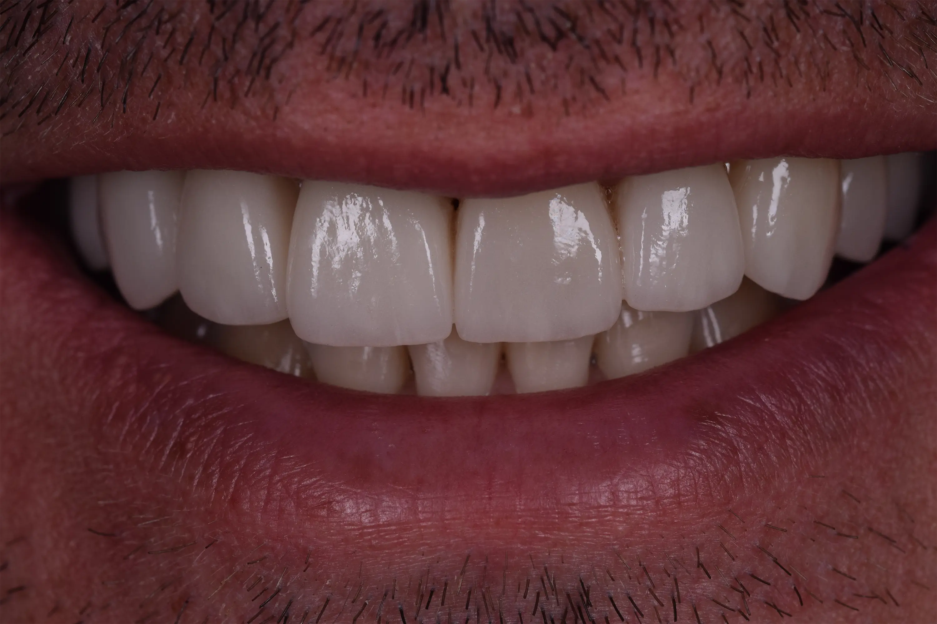 Fatete Ceramice si Coroane Zirconia pentru Uzura Dentară Generalizată – foto 2