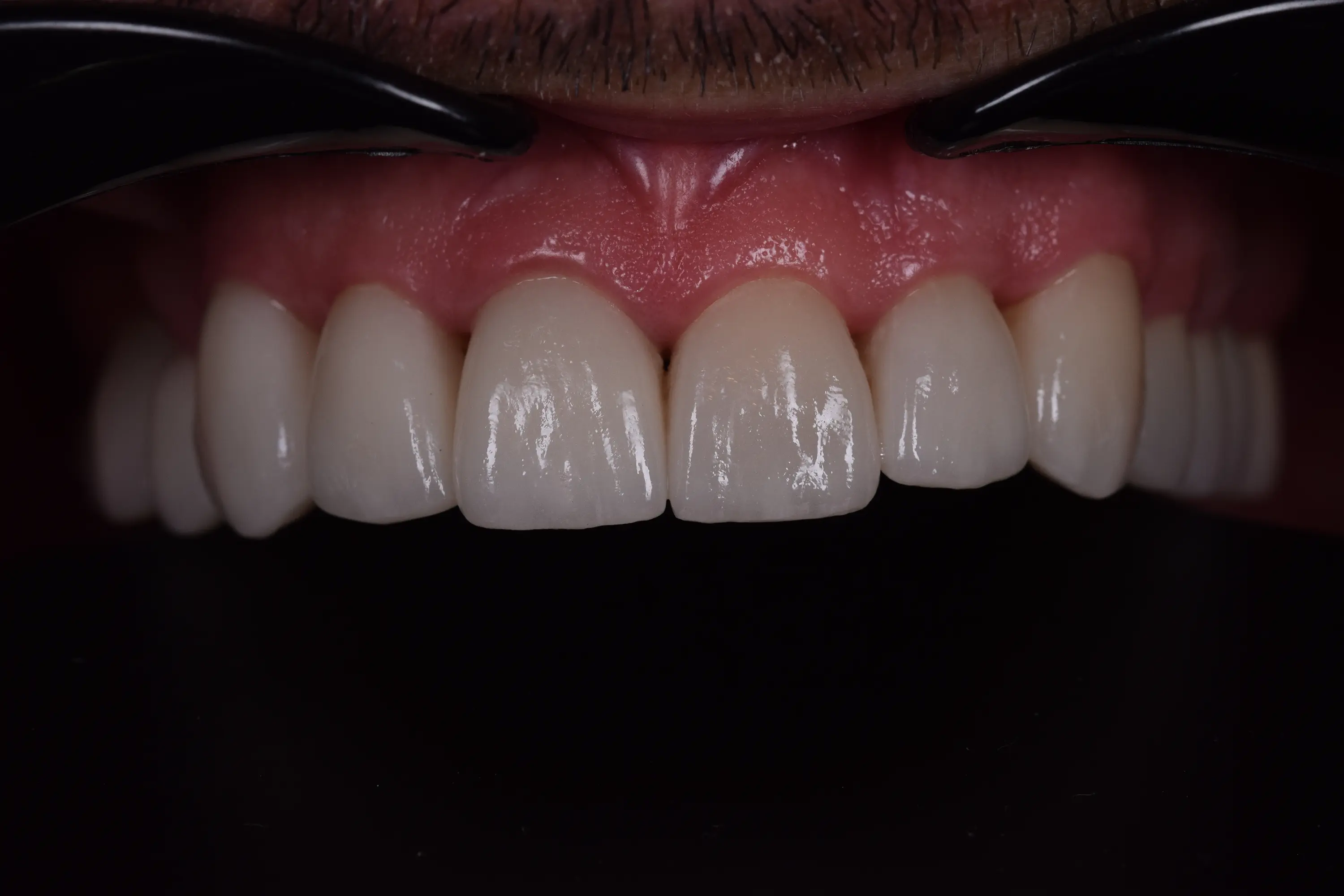 Fatete Ceramice si Coroane Zirconia pentru Uzura Dentară Generalizată – foto 4