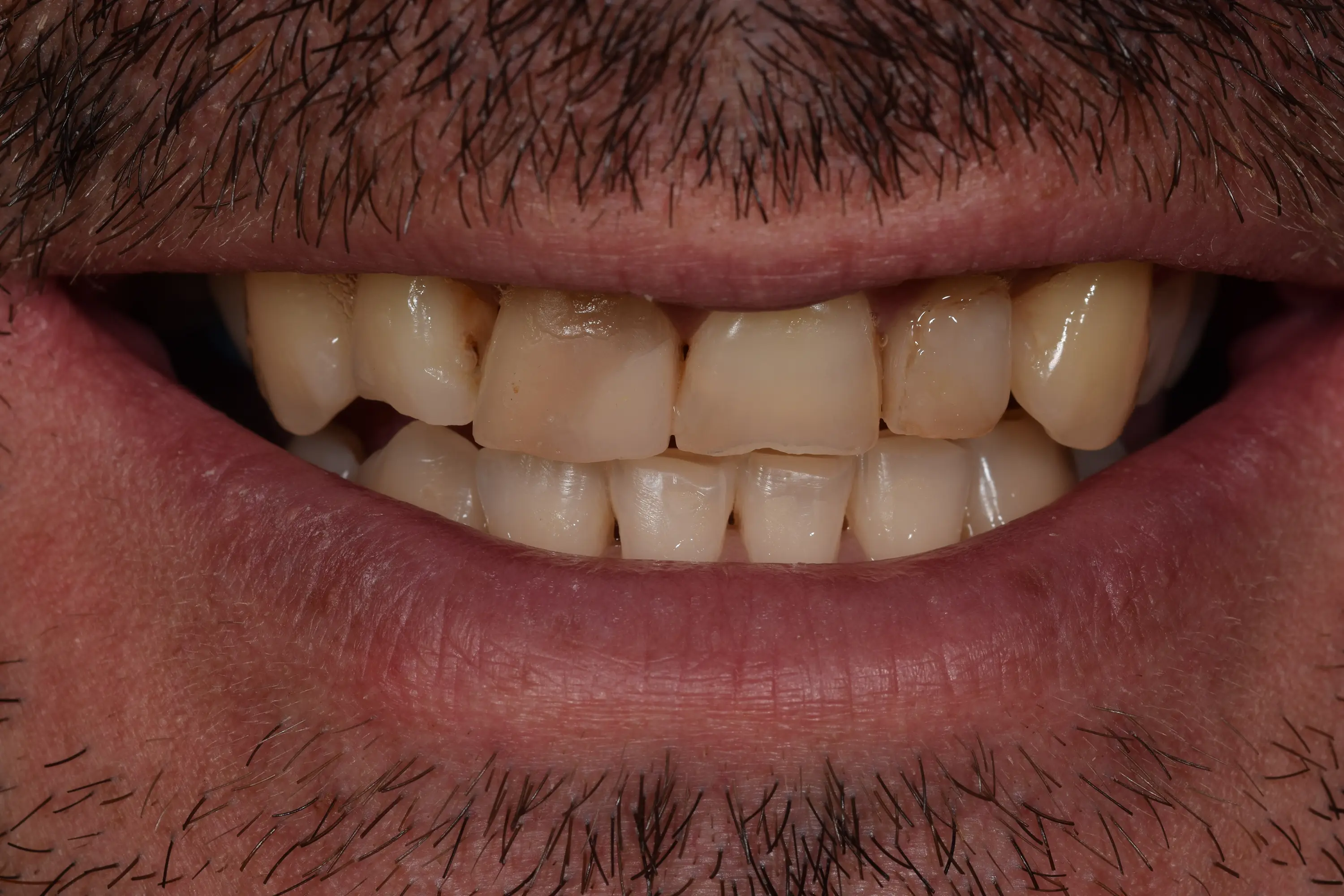 Fatete Ceramice si Coroane Zirconia pentru Uzura Dentară Generalizată – foto 1