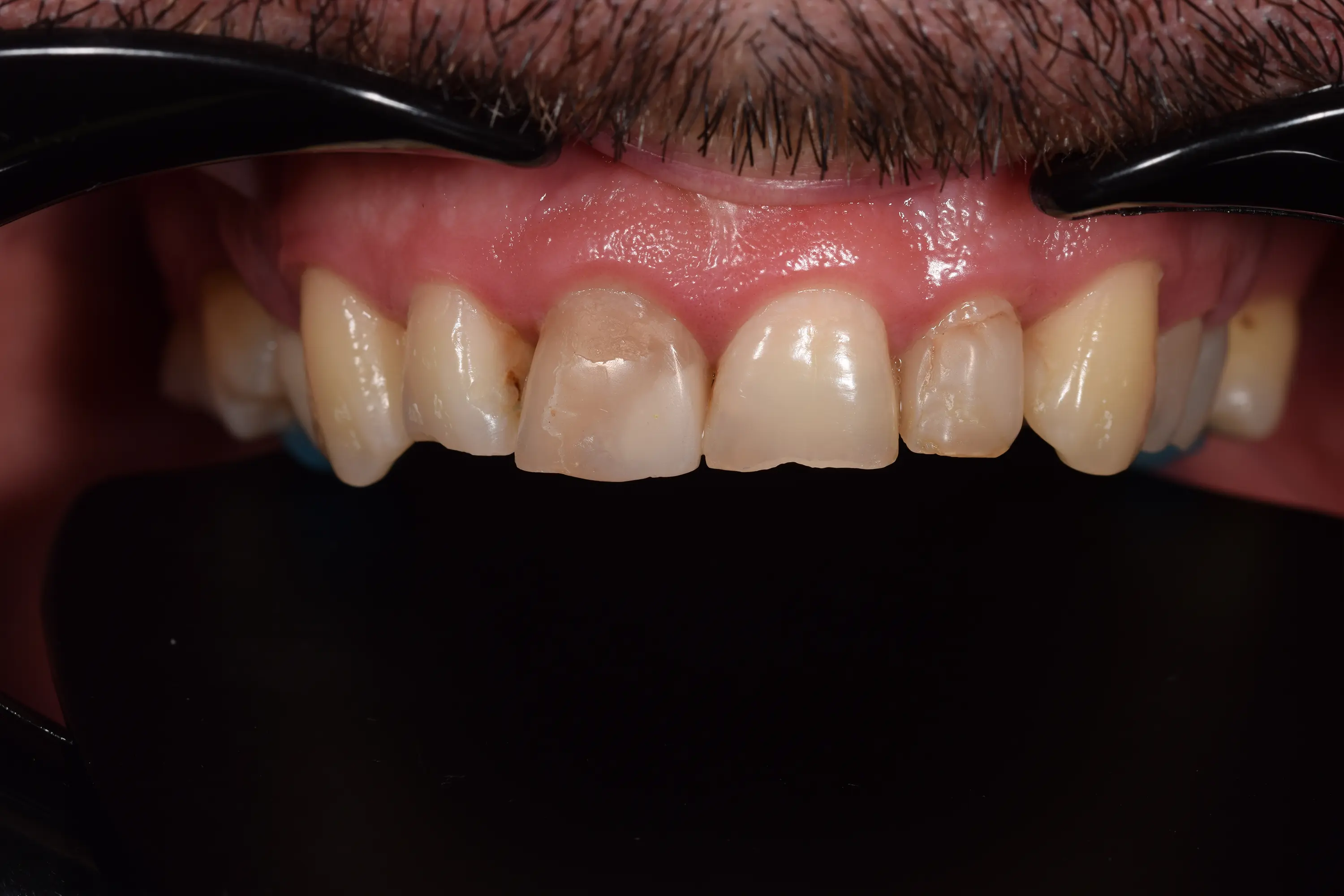 Fatete Ceramice si Coroane Zirconia pentru Uzura Dentară Generalizată – foto 3