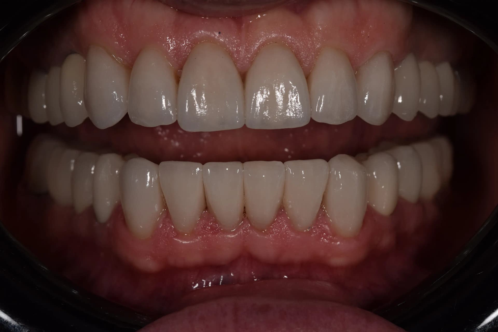 After Reabilitare Estetică și Funcțională: Redescoperirea unui Zâmbet Tânăr