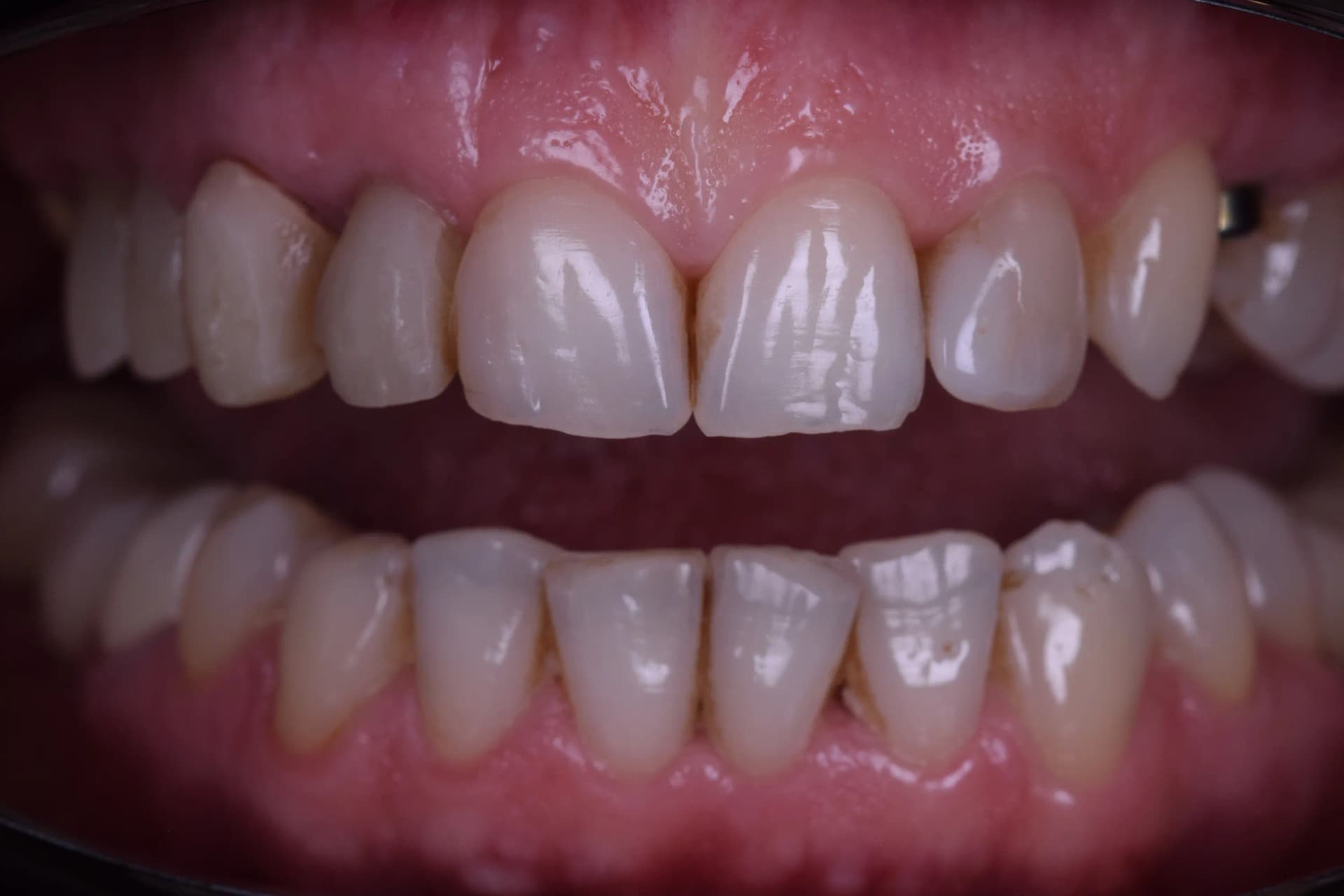 Before Rejuvenare Dentară Minim Invazivă: Corectarea Uzurii și Redobândirea Strălucirii